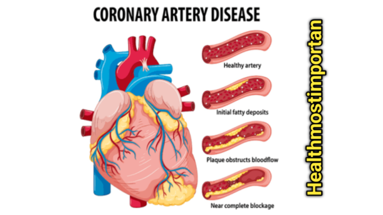 Coronary Artery Disease Ppt