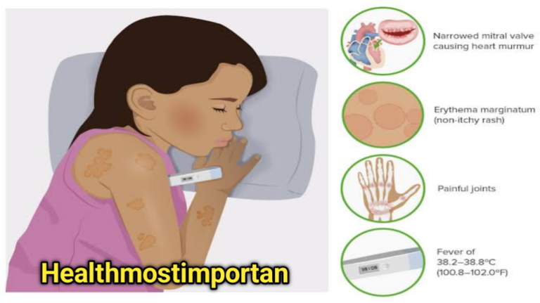 Rheumatic Fever Symptoms Mnemonic