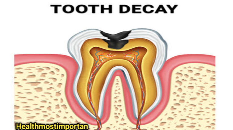 Tooth Decay Without Pain